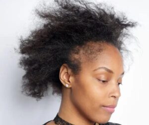 Alopecie-de-traction